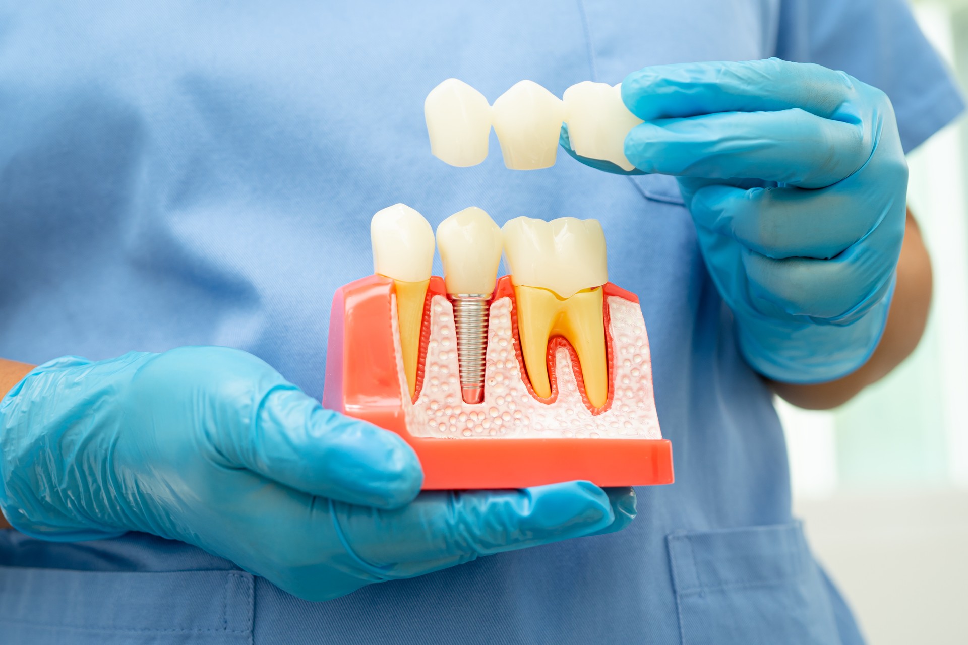 Dental implant, artificial tooth roots into jaw, root canal of dental treatment, gum disease, teeth model for dentist studying about dentistry.